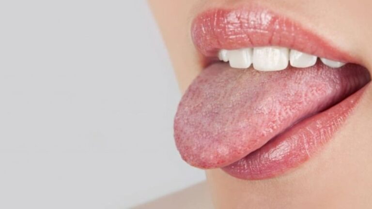 red-spots-on-tongue-under-back-tip-of-tongue-american-celiac