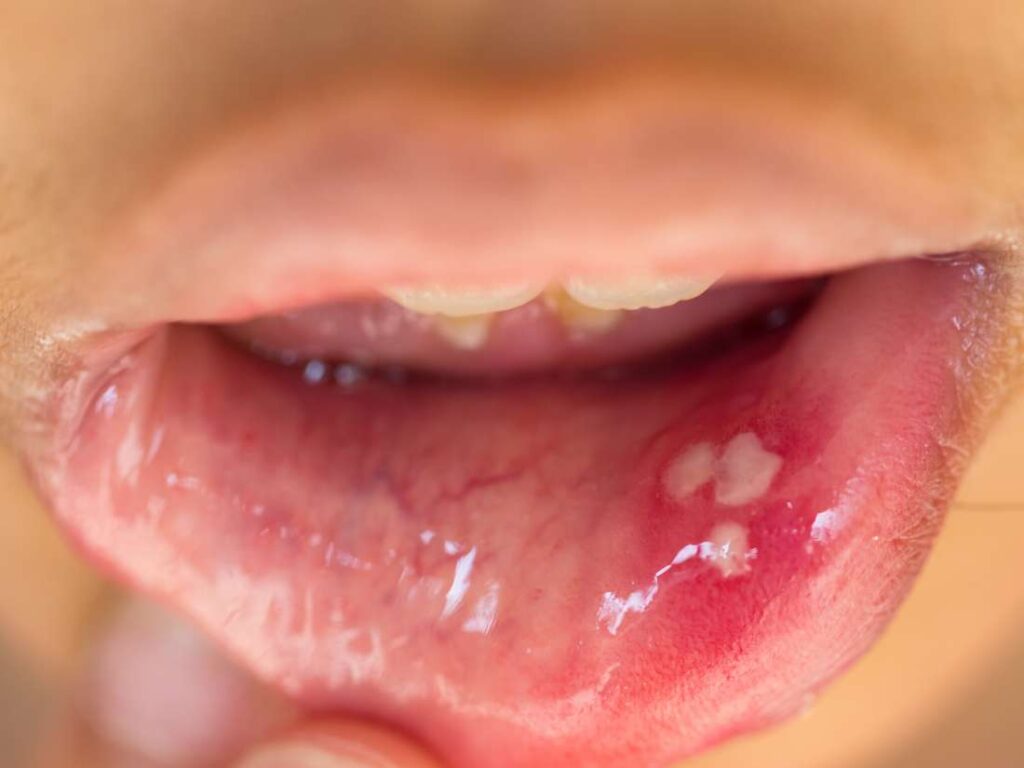 White Pimple On Tongue Mouth And Lips 1024x768 