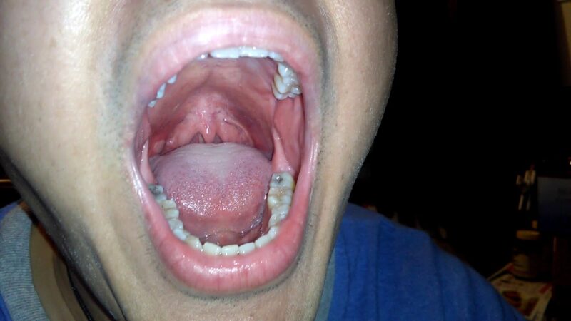 hpv-white-spots-on-lip