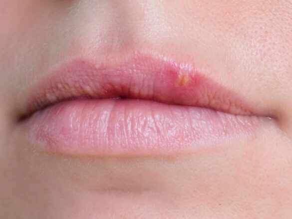 White Spots on Lips Causes, Pictures, Small, on Lower, Upper, Inside ...