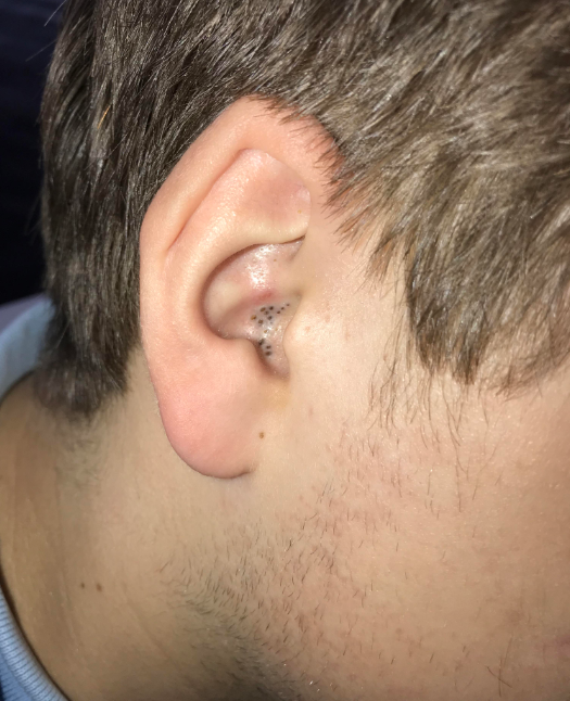 blackheads in ear