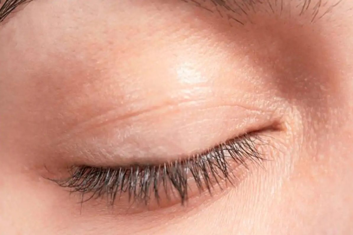 Oily Eyelids Symptoms, Causes, Treatment and Remedies American Celiac