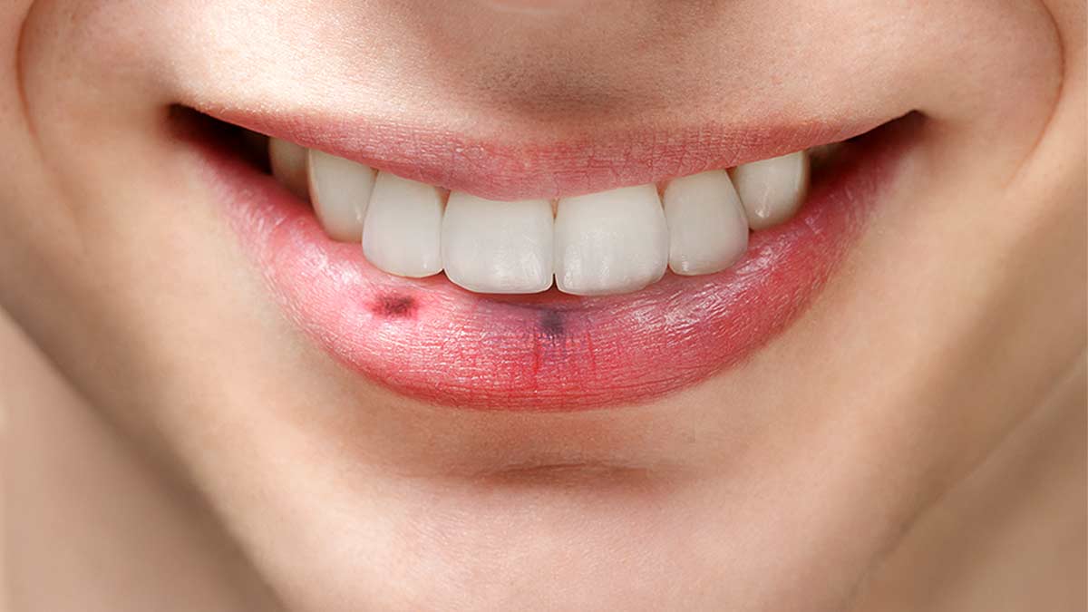 Black or Dark Spot on Lips Pictures, Cause, How to Get Rid Fade or