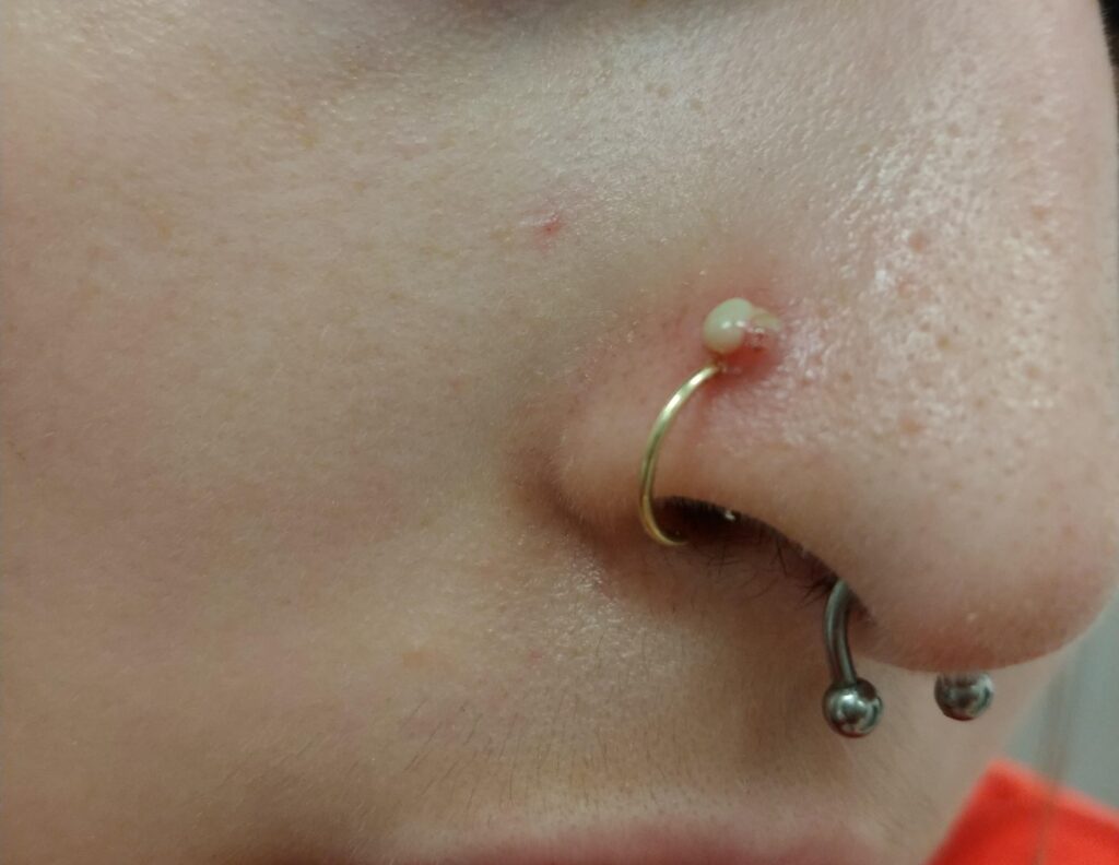 Infected Nose Piercing Pictures Symptoms Treatment Bump Home