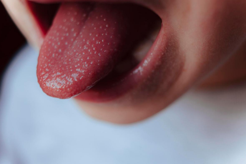 red-spots-on-tongue-under-back-tip-of-tongue-american-celiac