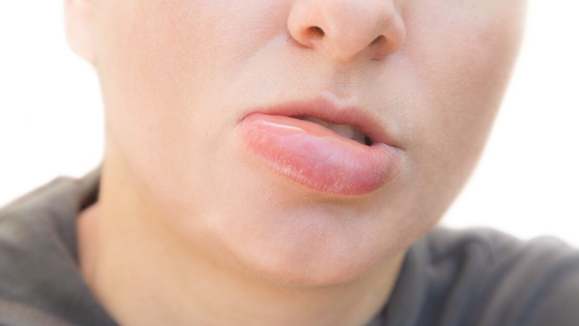 Swollen Bottom Lip, Causes, For No Reason, Treatment of Lower Lips