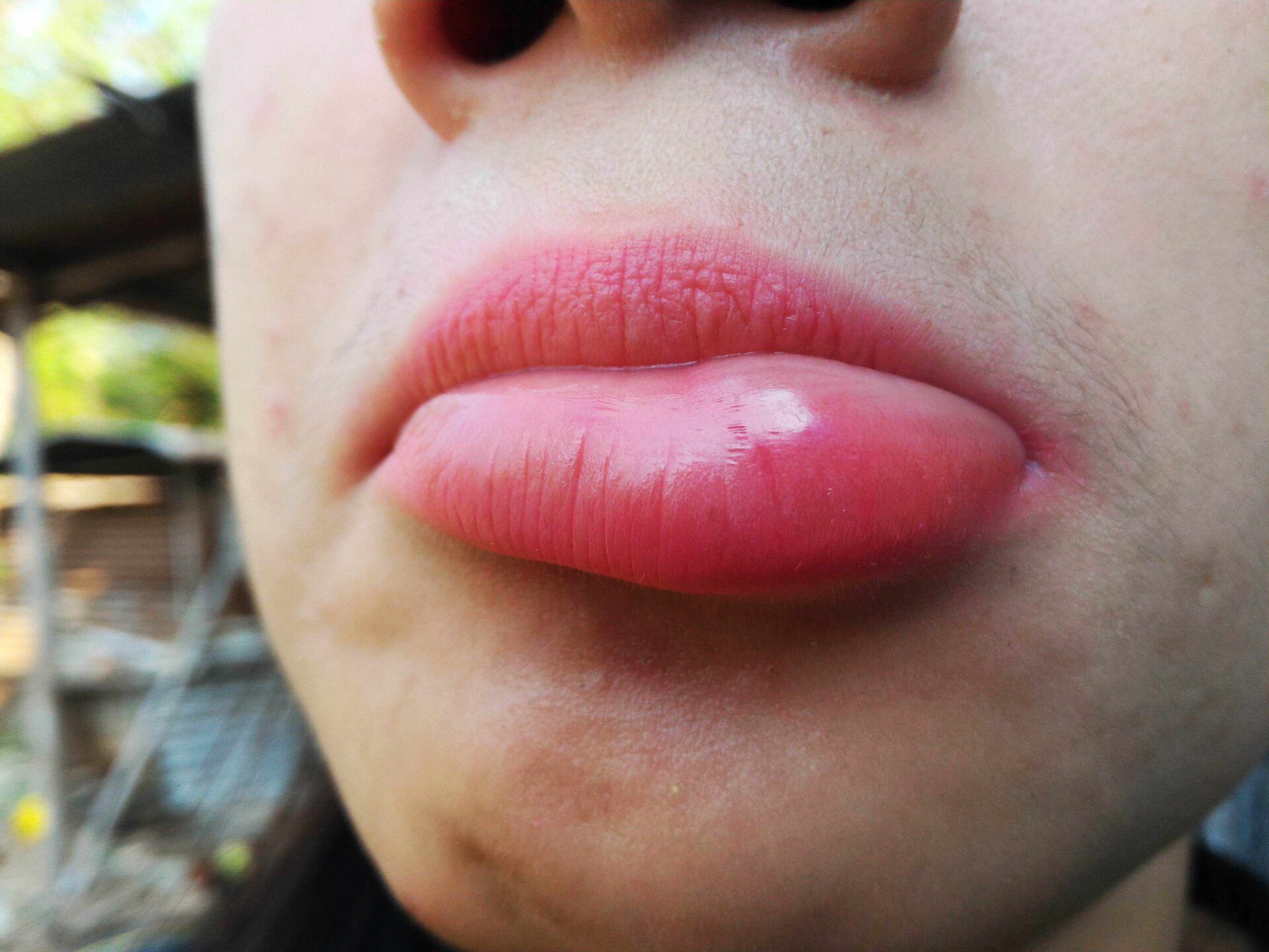 swollen-bottom-lip-causes-for-no-reason-treatment-of-lower-lips