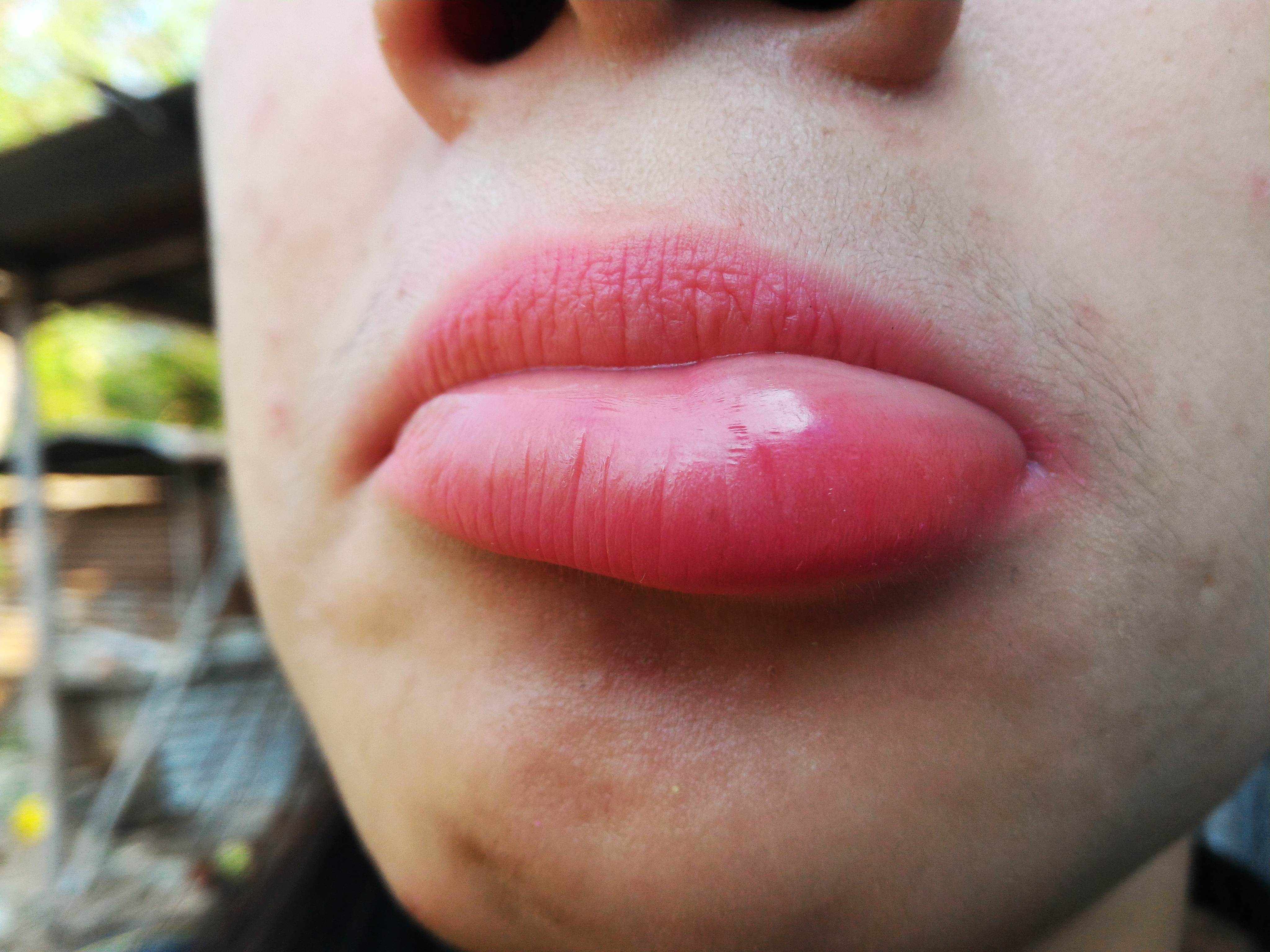 фото порванной губы