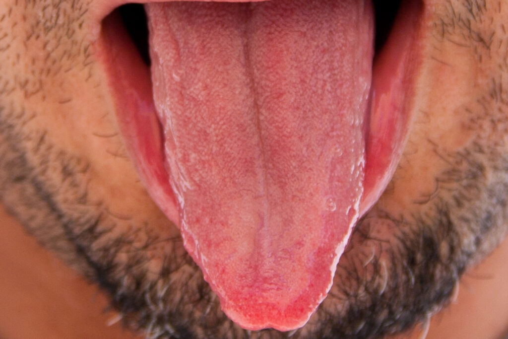 Swollen Taste Buds Tongue 1024x683 