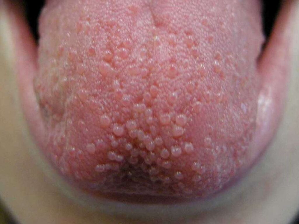 red-spots-on-tongue-under-back-tip-of-tongue-american-celiac-images