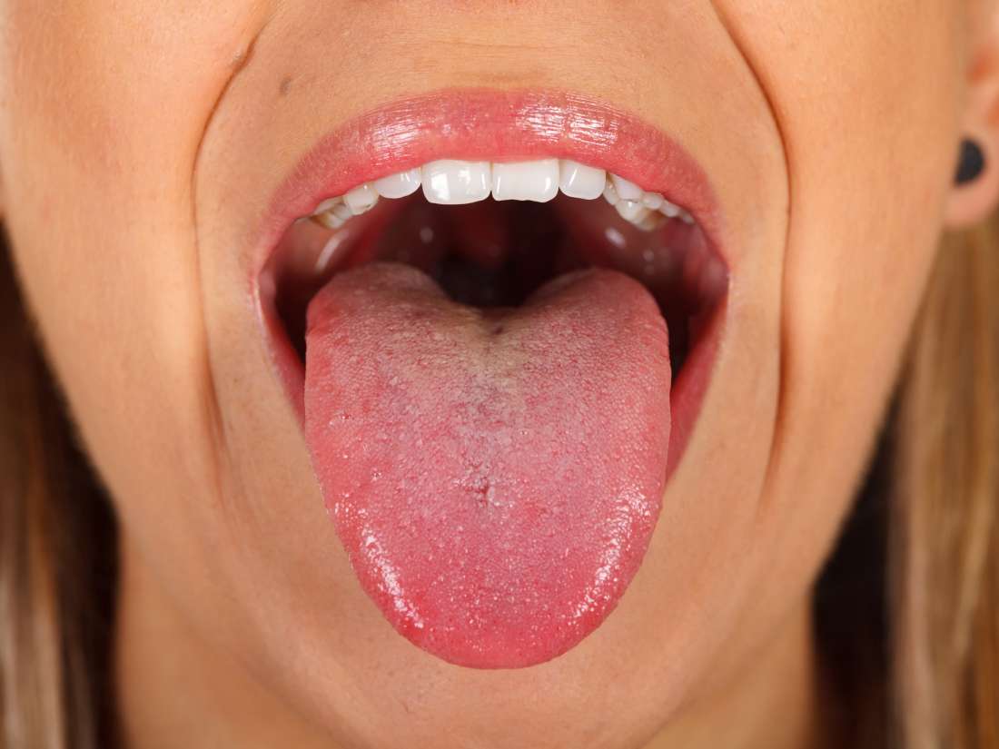 Tongue Swelling Causes, Symptoms, Treatment, Piercing, under & One Side