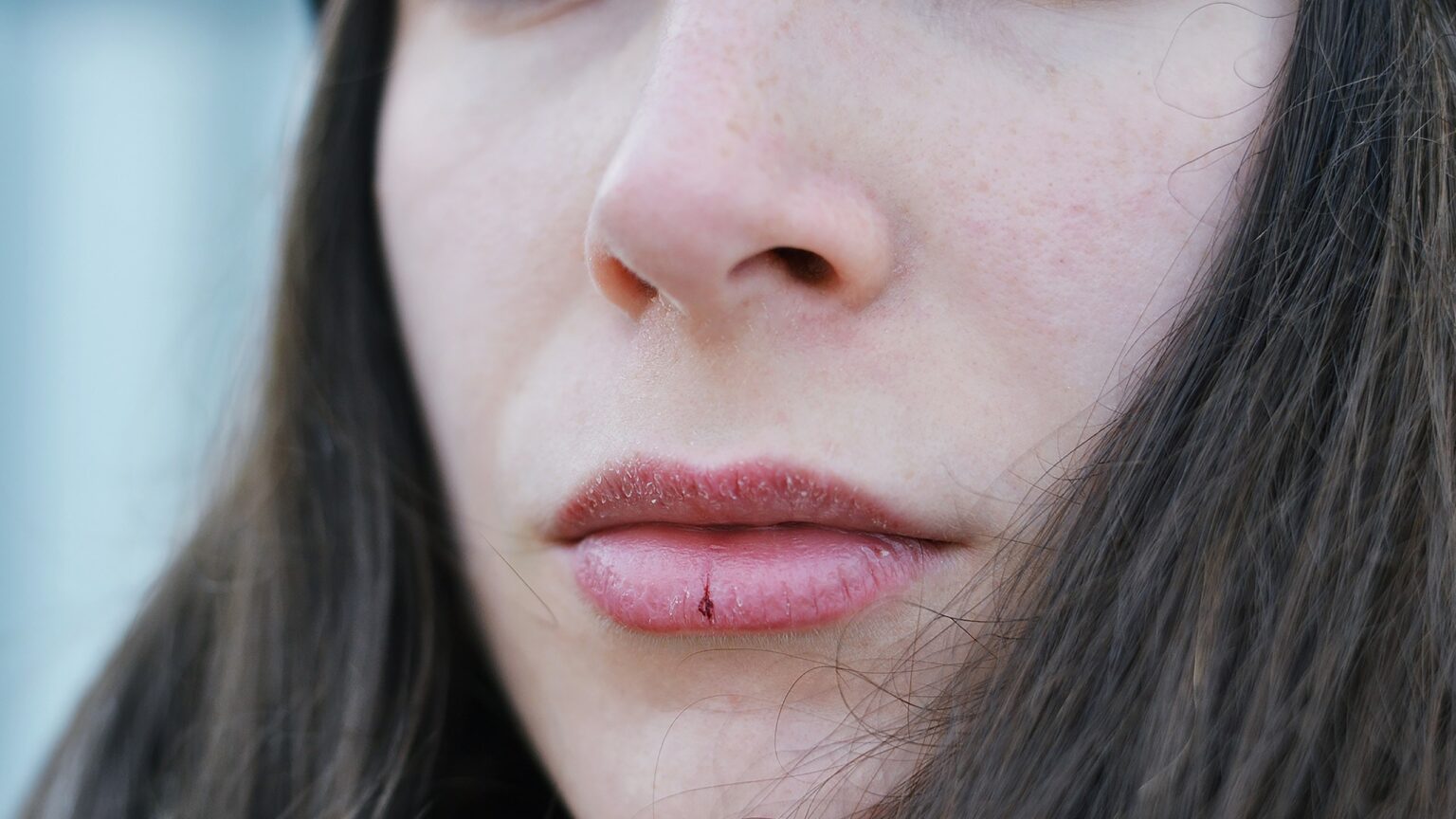 Get Rid of Lip Pimples Swollen, Big, Painful, Upper, Inside Around Your