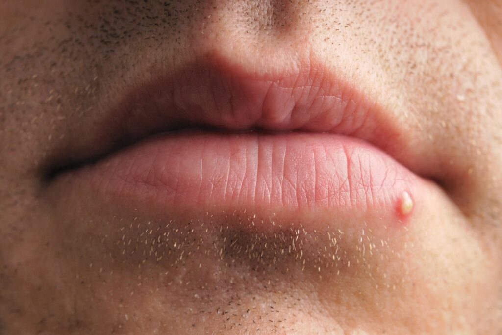 white-spots-on-lips-causes-pictures-small-on-lower-upper-inside