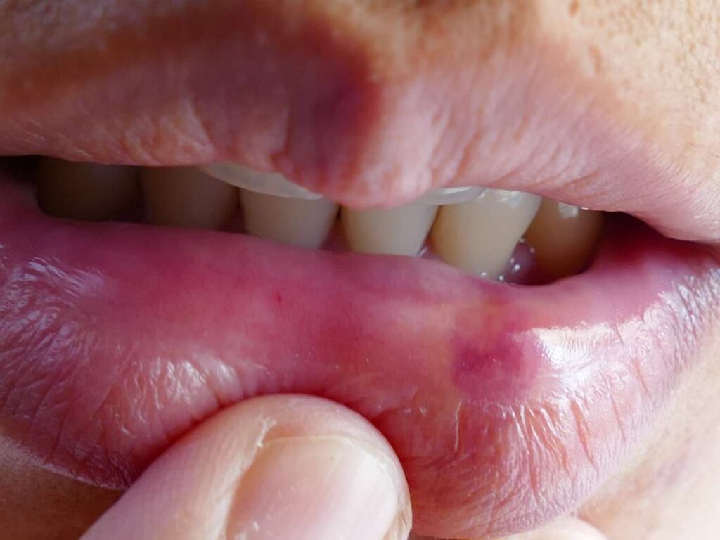 Bumps Inside Lips Causes Small Clear White Or Red Bumps Treatments And Remedies American Celiac