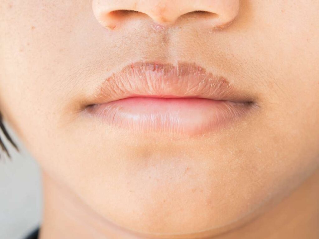 Lip Peeling Pictures, Dry Lips, Cheilitis, Hypothyroidism  