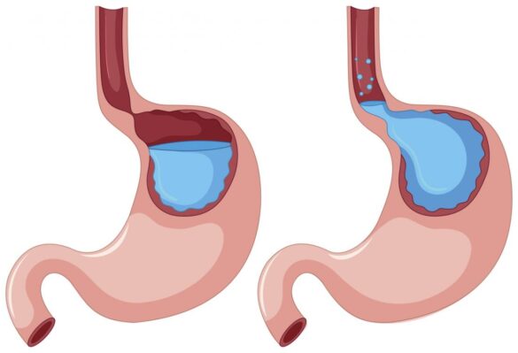 stomach-pain-after-drinking-alcohol-american-celiac