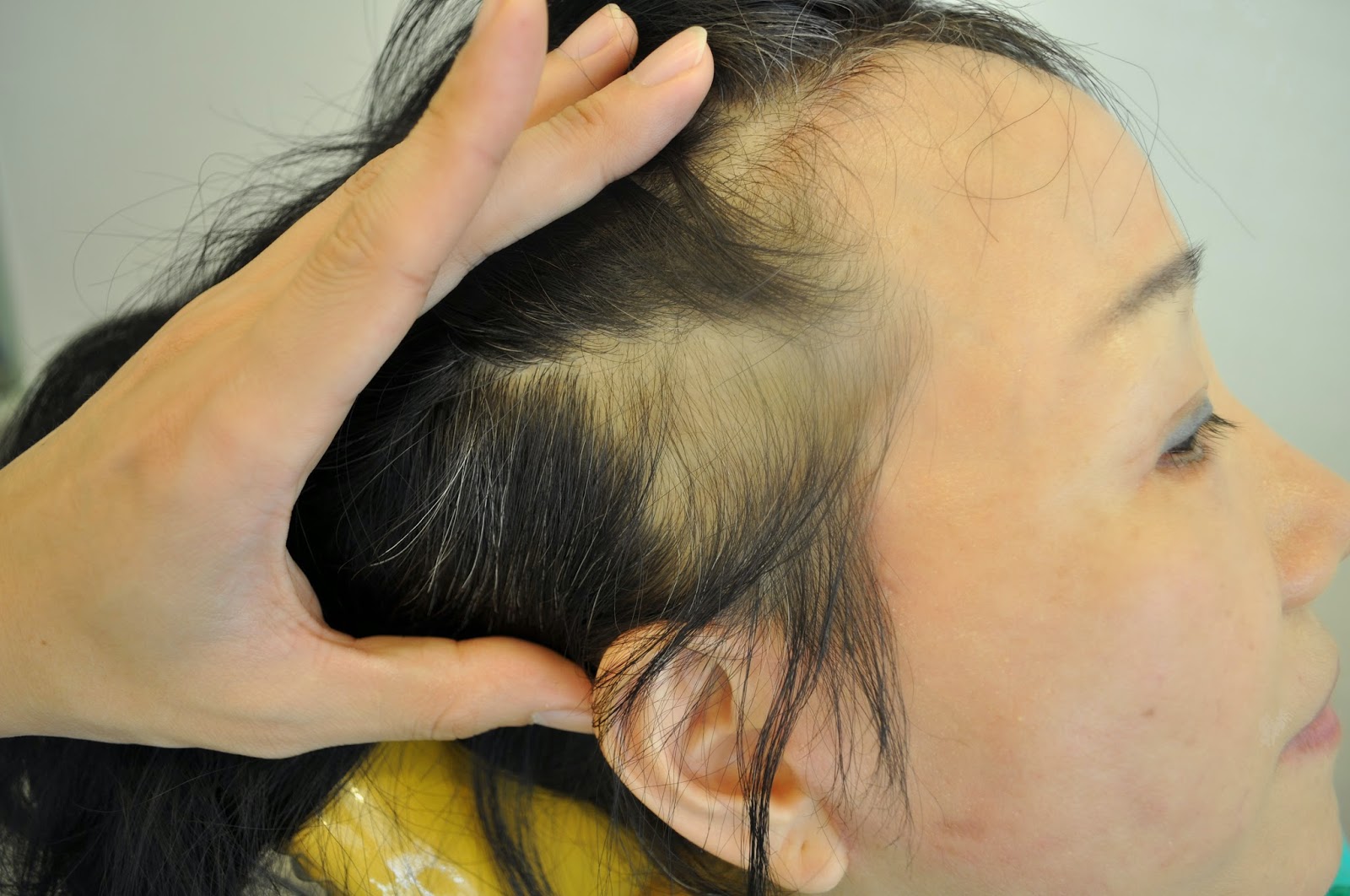 Hair Transplant Receding Hairline 