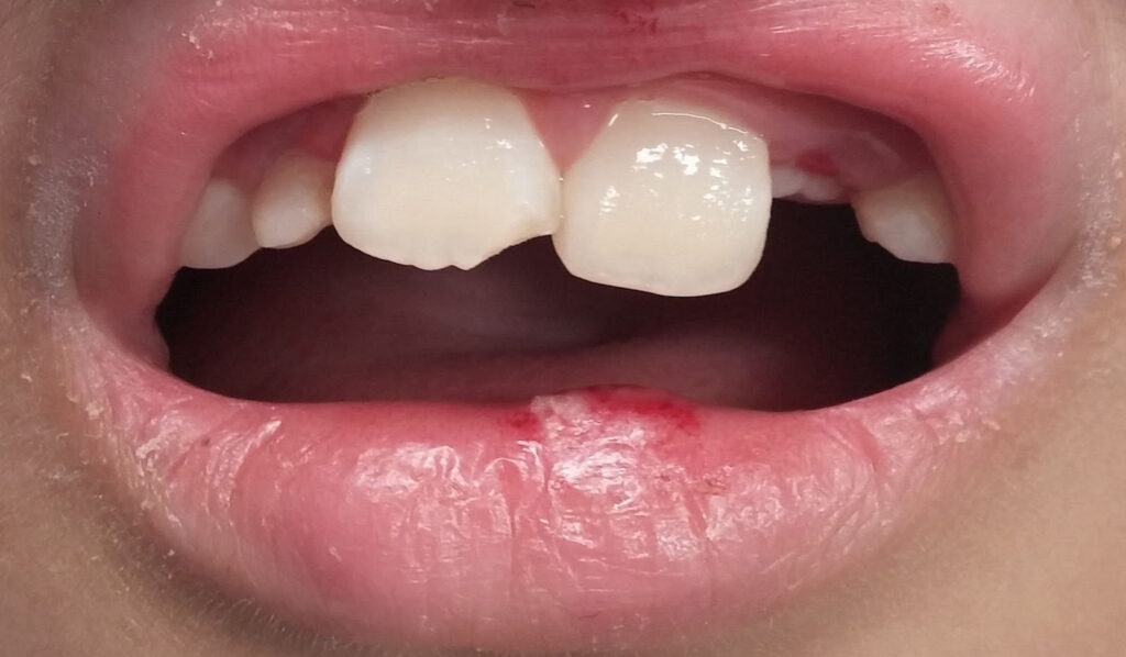 bump-inside-lip-symptom-causes-treatments-local-dentist