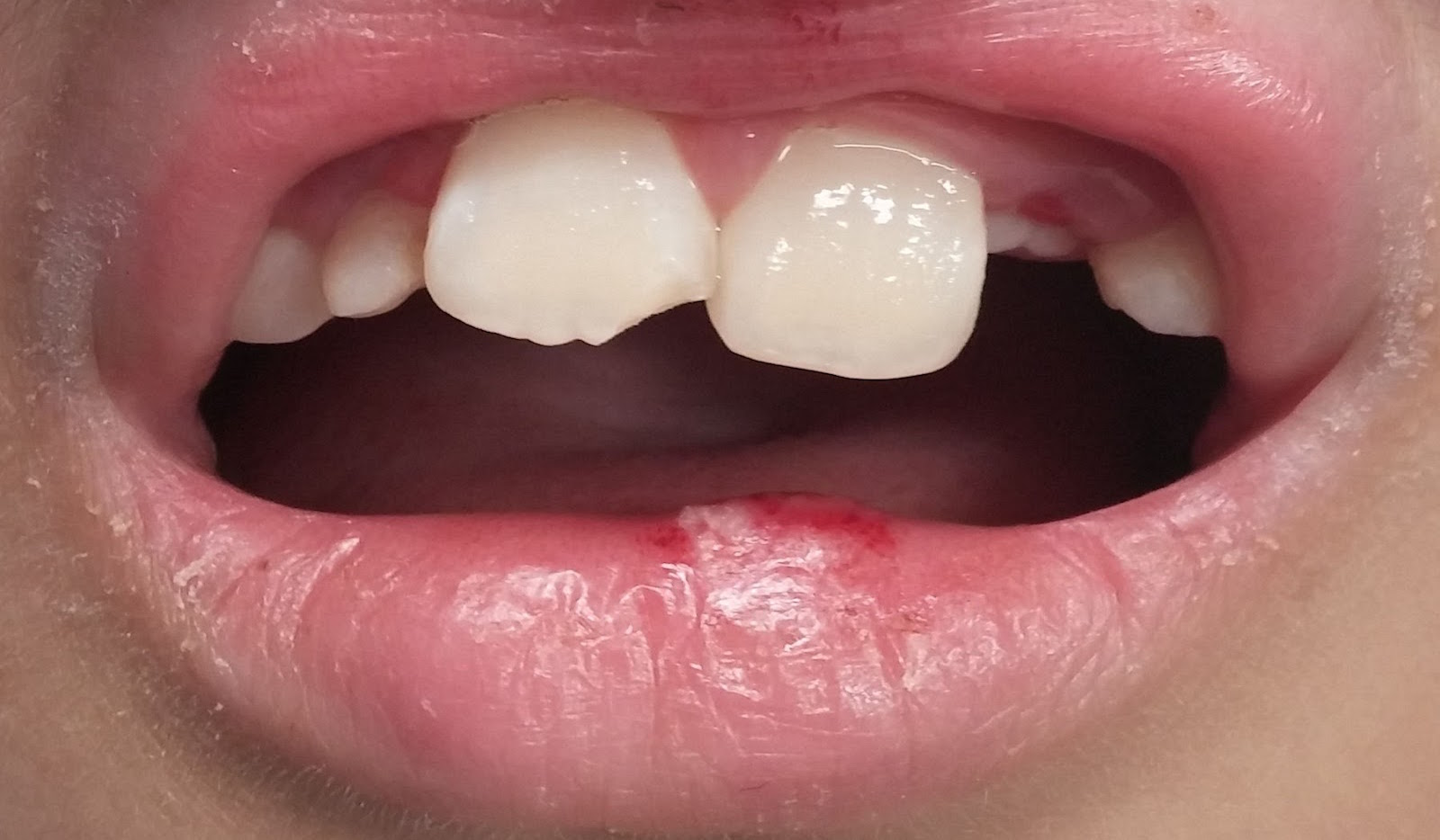 Bumps Inside Lips Causes Small Clear White Or Red Treatments.