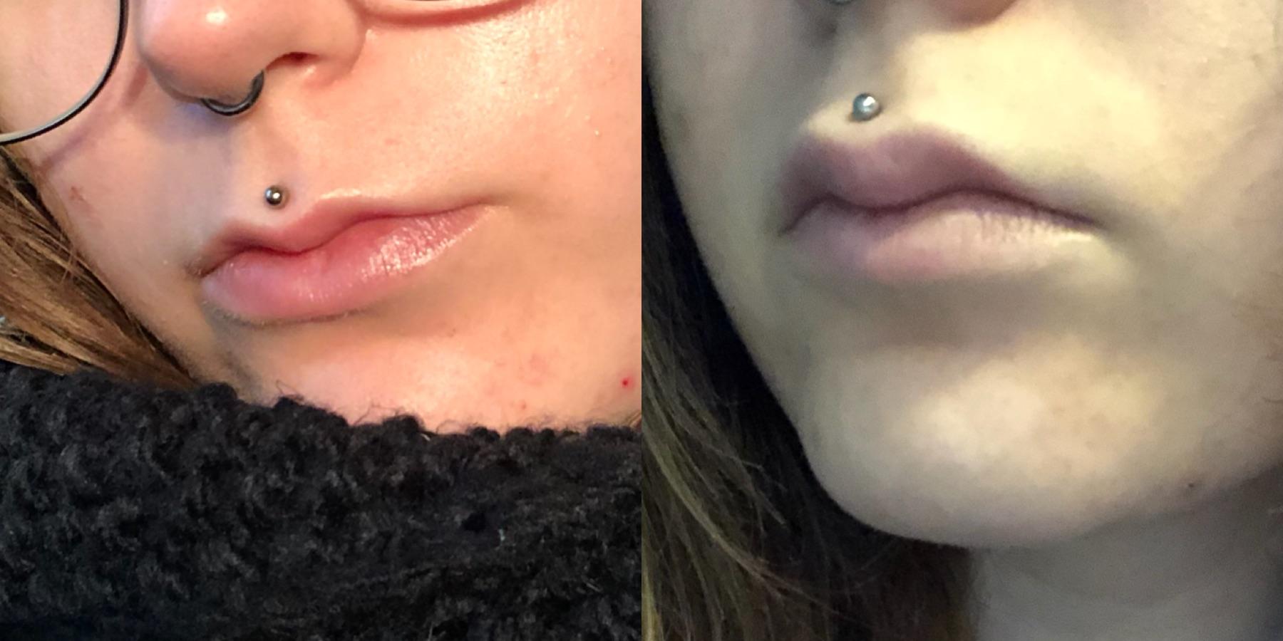 Medusa Piercing Pictures, Swelling, Aftercare, Scar, Jewelry and
