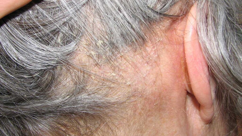 Crusty Behind Ears Causes, Symptoms, Dry Skin, Psoriasis, Skin