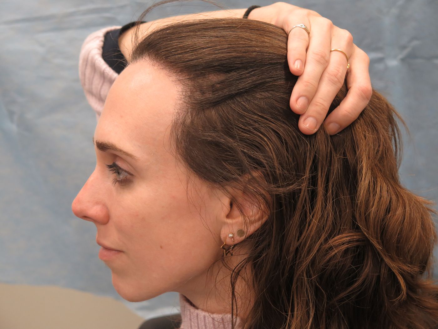 Receding Hairline in Women Signs, Causes, Reversal Surgery, Hair