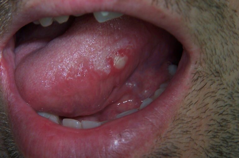 transient-lingual-papillitis-or-lie-bumps-causes-and-lie-bumps-treatment