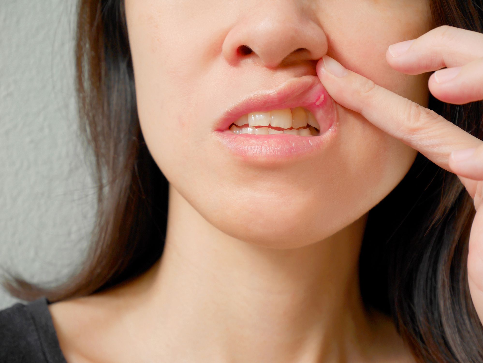 Biting inside of lip causes while eating anxious on bottom lip how