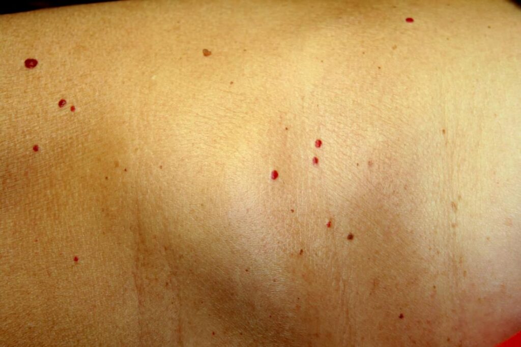 Red Itchy Spots On Upper Chest At Charles Kelly Blog