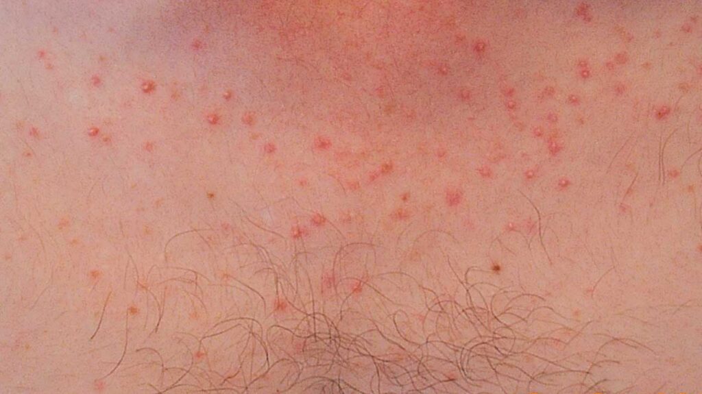 Bumps on Chest, Small, Red, Rashes, Acne Vulgaris and Bumps not Acne