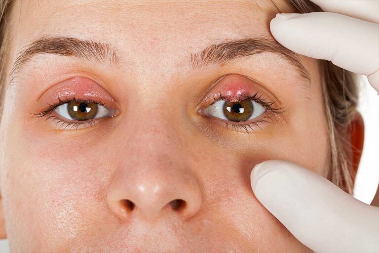 Eyelid Redness Causes, Symptoms, Inflamed, Dry Itchy Swollen Red ...