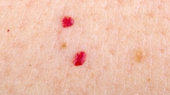 Bumps on Chest, Small, Red, Rashes, Acne Vulgaris and Bumps not Acne