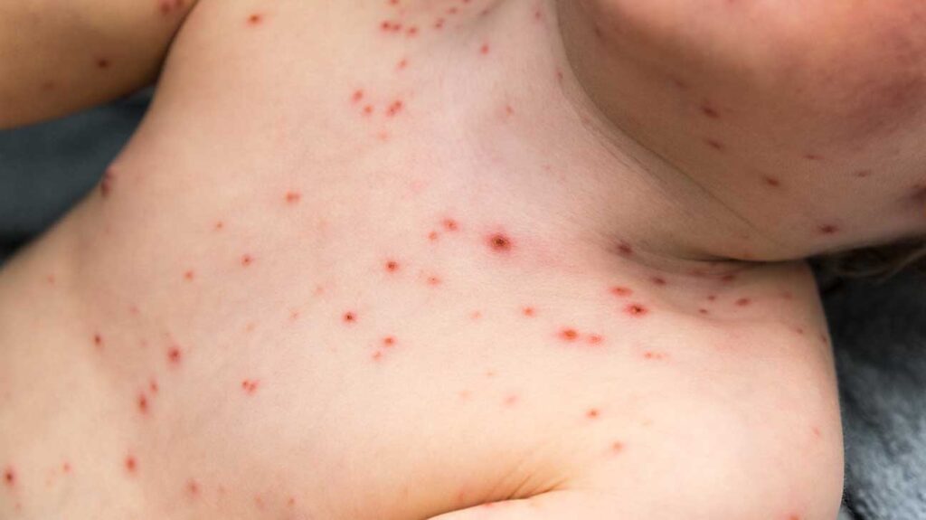 bumps-on-chest-small-red-rashes-acne-vulgaris-and-bumps-not-acne