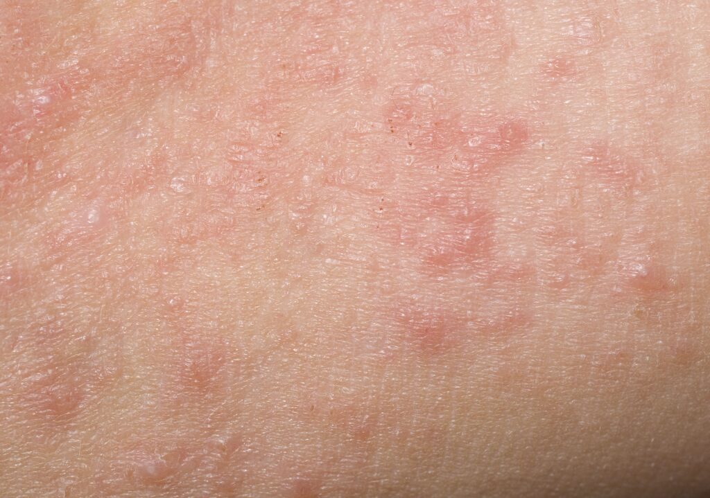 What Does A Rash With Bumps Mean