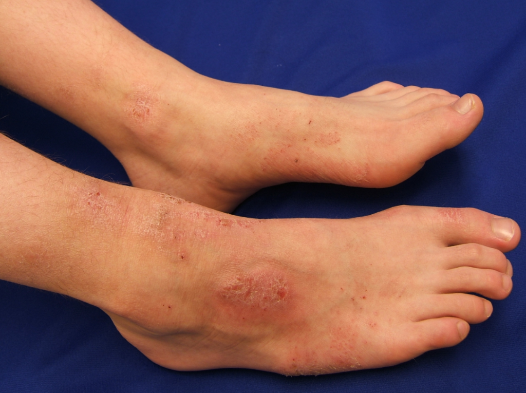 red-spots-on-legs-causes-small-raised-flat-or-itchy-skincarederm