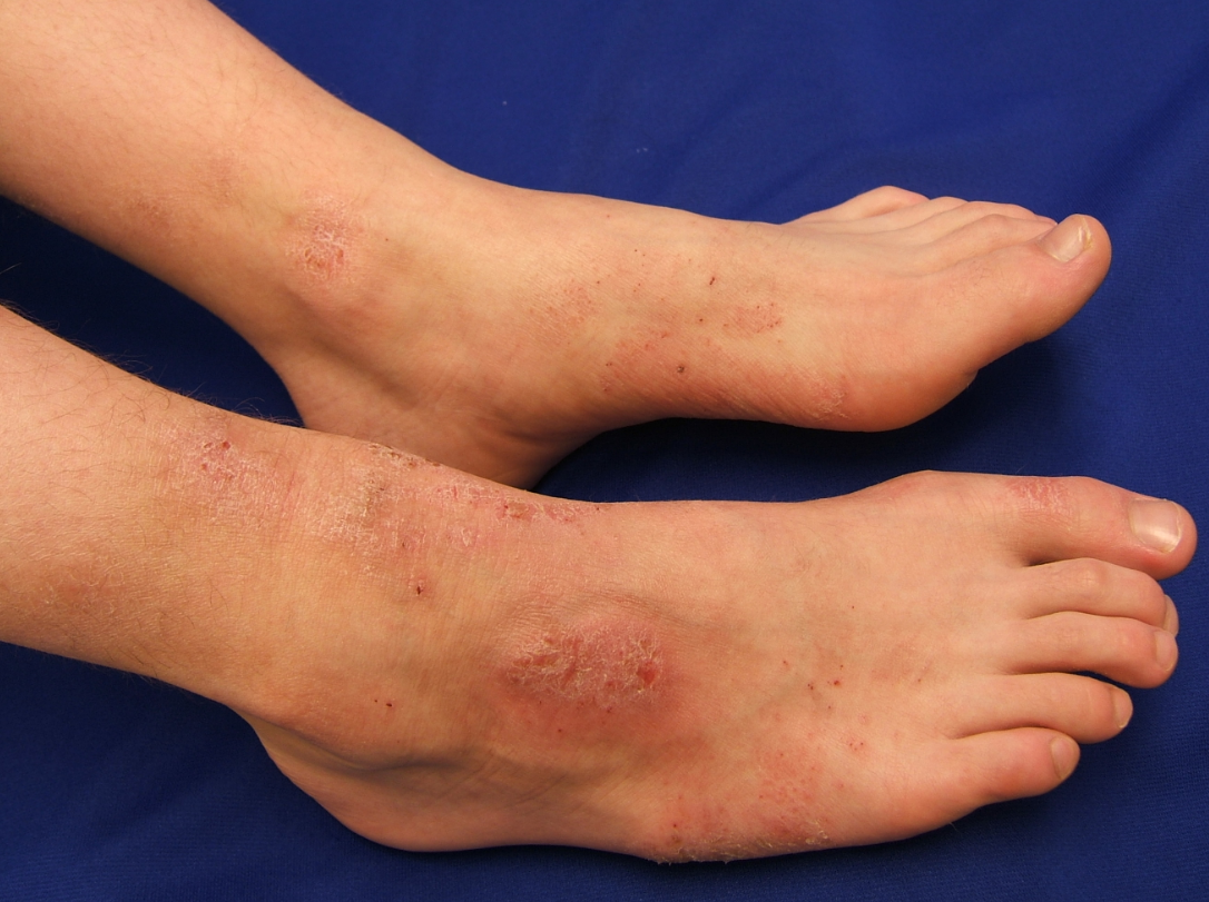 What Causes Red Blotches On Lower Legs