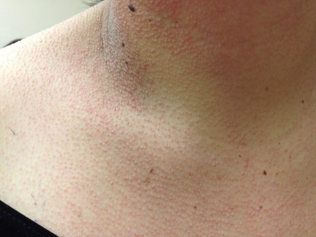 Random Bumps On Chest