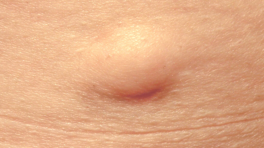 lymph nodes in armpit
