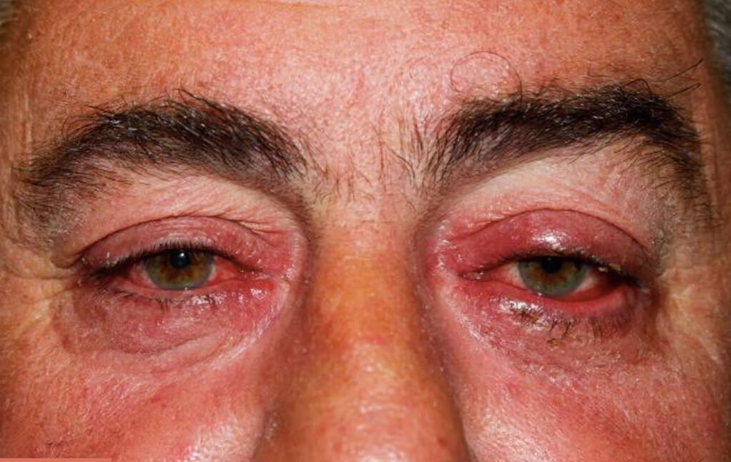 Eyelid Redness Causes, Symptoms, Inflamed, Dry Itchy Swollen Red