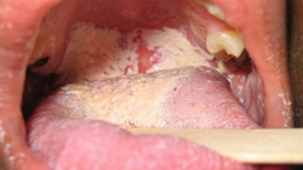 oral gonorrhea symptoms