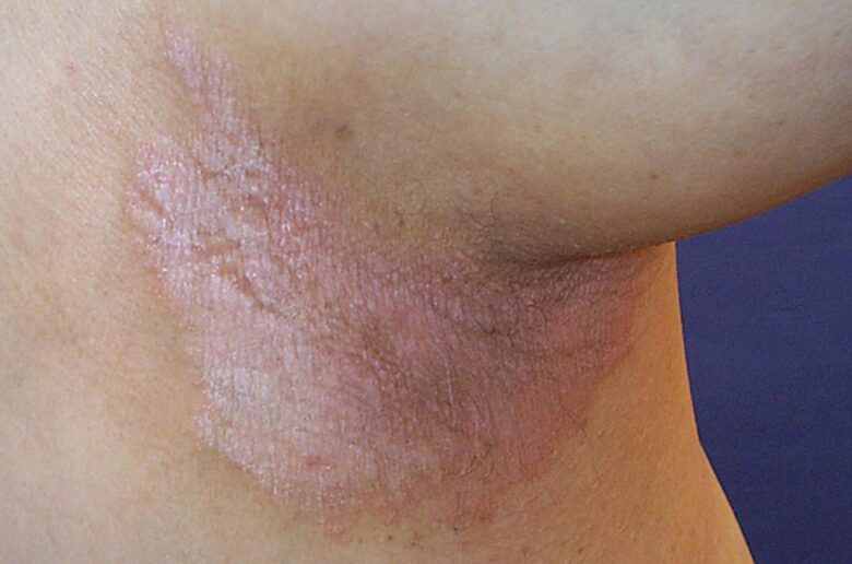 Itchy Armpits Causes, Shaving, Cancer, Pregnancy, Red & No Rash