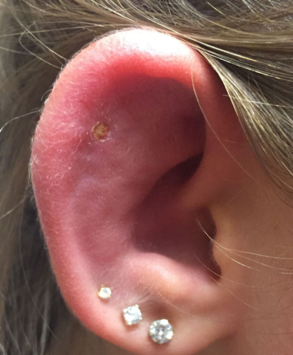 Ear Piercing Infection Causes Symptoms Pictures Bump And Treatment 