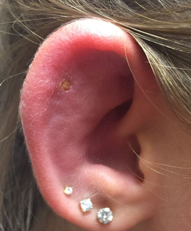 Ear Piercing Infection Causes Symptoms Pictures Bump And Treatment ...