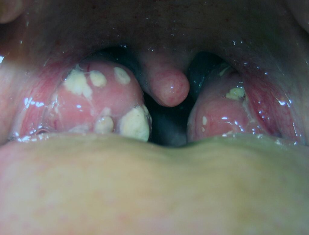 White Spots, Patches Bumps on Tonsils Causes STDs