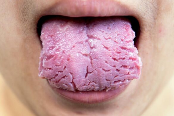 Inflamed Enlarged Or Swollen Taste Buds On Back Tip Or Side Of Tongue