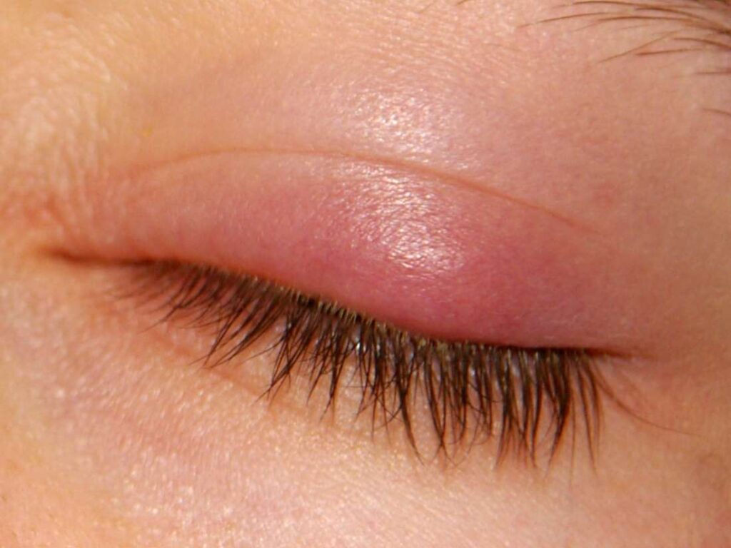 eyelid red and swollen