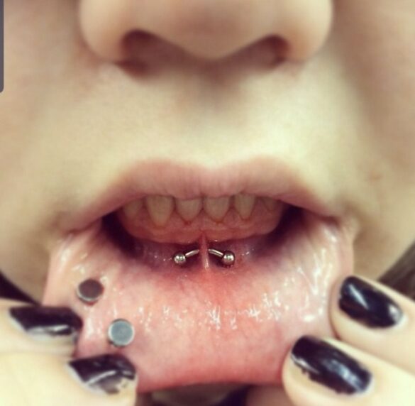 Smiley Piercing, Anti-Smiley Pictures, Cost, Healing, Infection, Risks