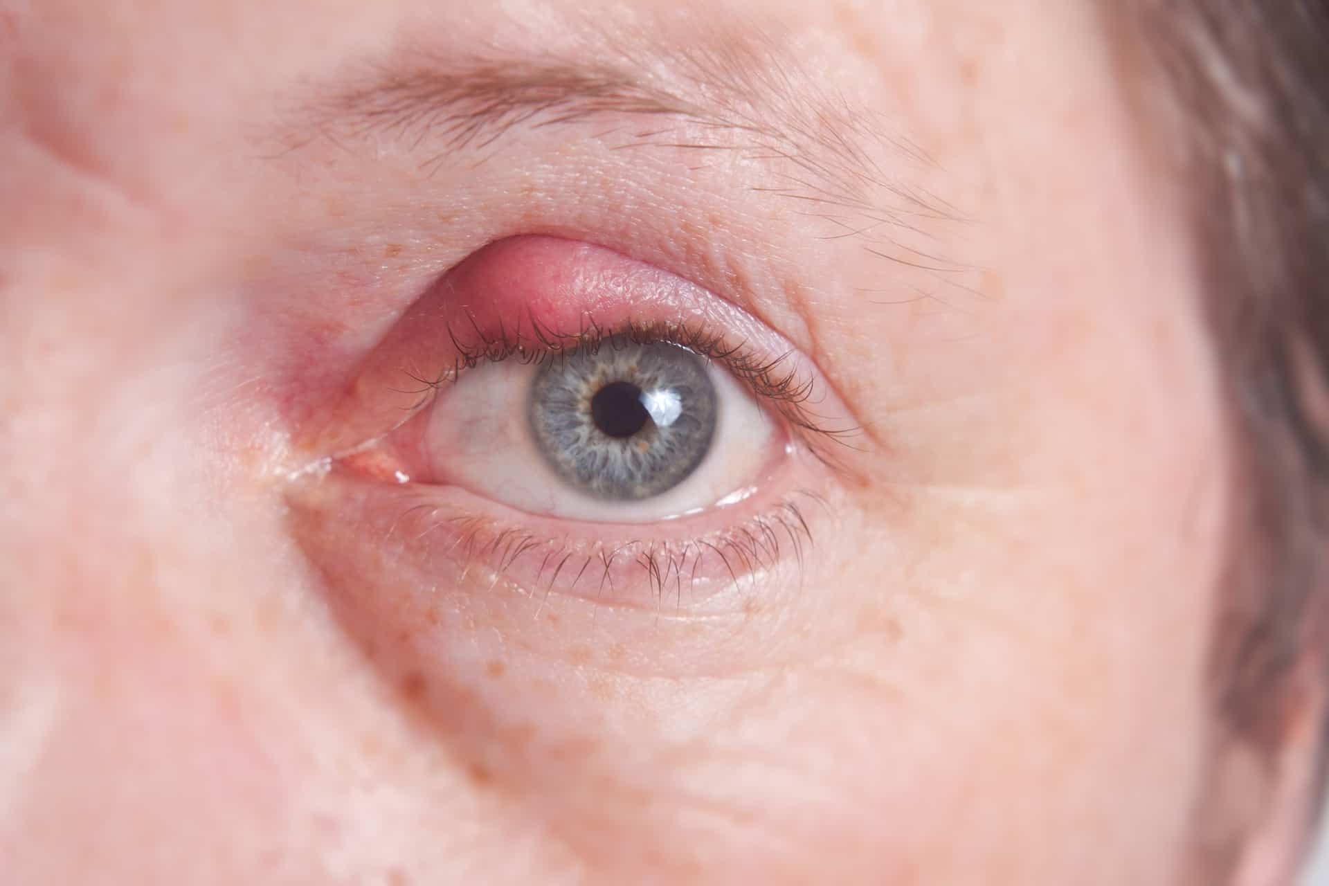 Eyelid Redness Causes Symptoms Inflamed Dry Itchy Swollen Red 