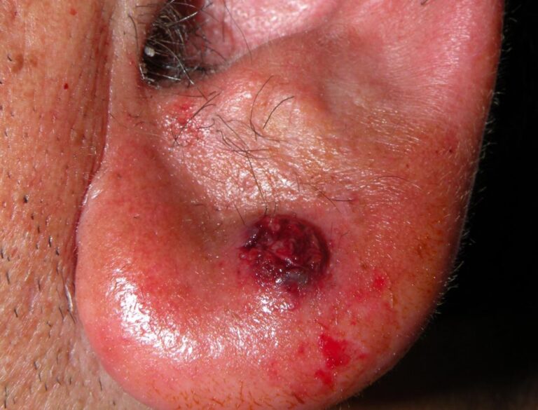 Swollen Ear Lobe Causes Piercing Abscess Infection And Treatment