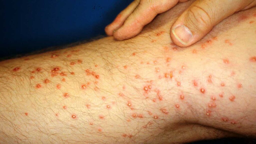 red bumps on legs that itch at night